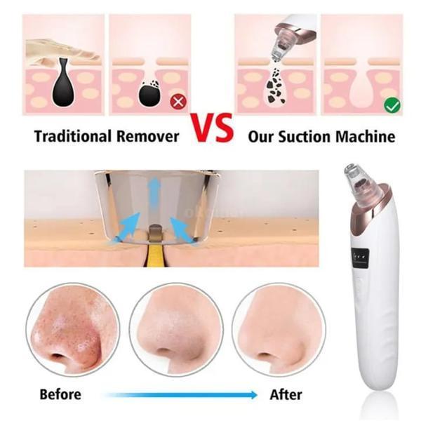 Blackhead Removing tool